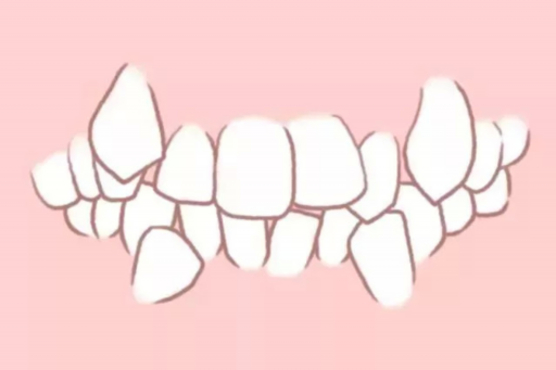 儿童龅牙什么时候整牙(小孩牙齿龅牙什么时候矫正最好)(图1)